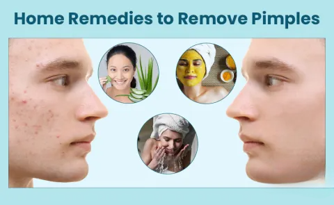 Best Home Remedies for Pimples (Backed by Science)