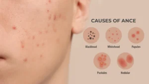 Different types of acne