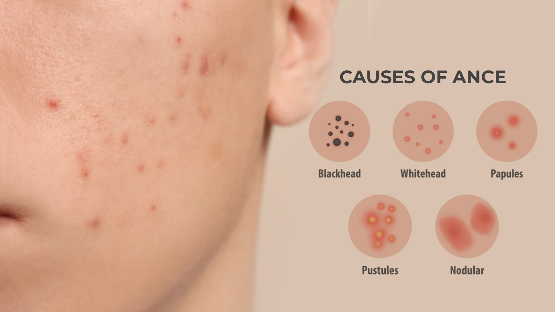 Different types of acne