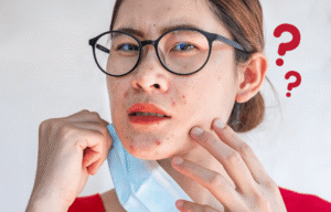 10 Common Myths About Acne (And The Truth)