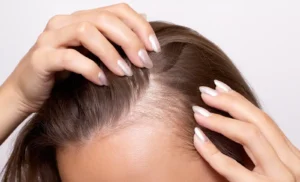 Hair Fall in Women: 7 Hormonal Reasons You Didn’t Know About