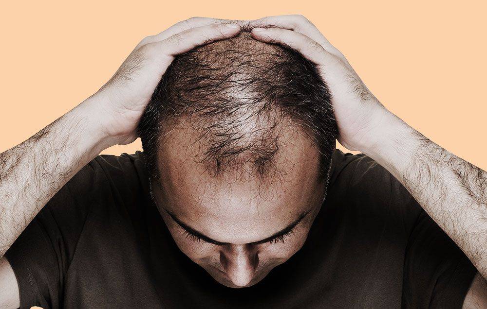 What Really Causes Hair Loss