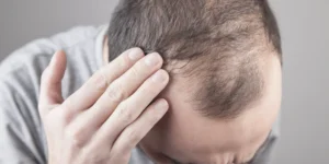 DHT & Hair Loss: The Hidden Hormone Behind Baldness