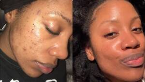 What Is Acne and Why Does It Happen?