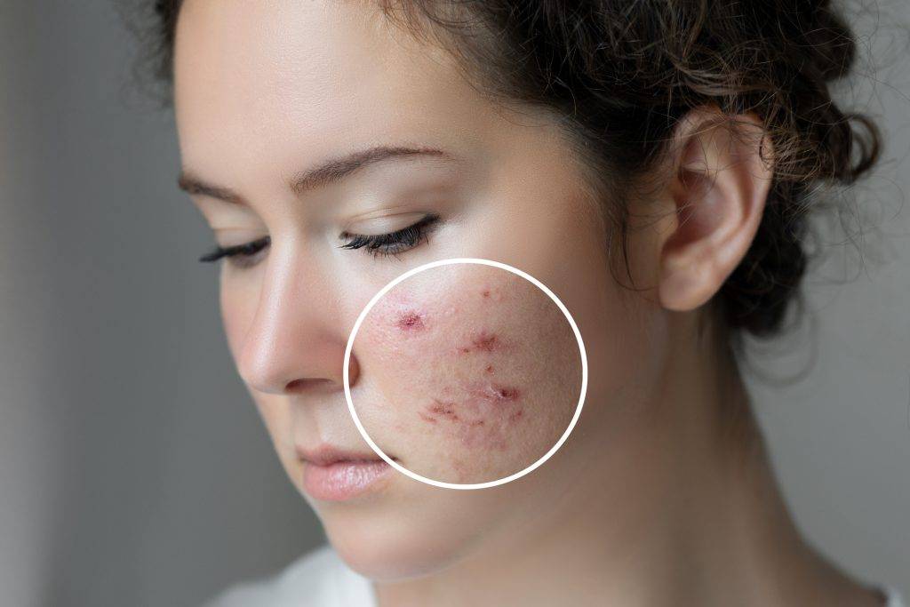 Causes of Acne You Didn’t Know About