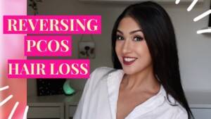 PCOS & Hair Loss: How to Get Your Hair Back Naturally