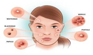 How Hormones Affect Your Skin: Acne & Puberty Explained