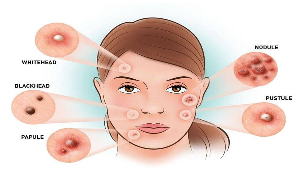 How Hormones Affect Your Skin: Acne & Puberty Explained